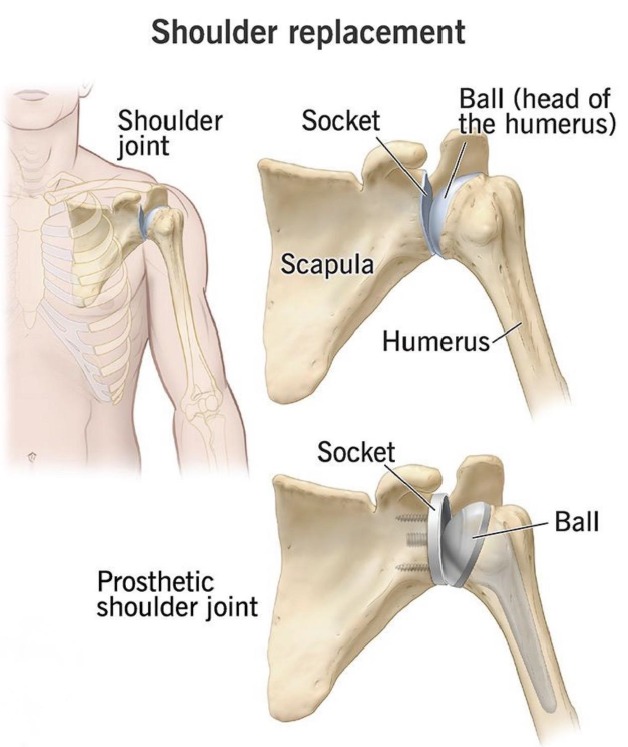 Life after shoulder replacement surgery in Bangalore